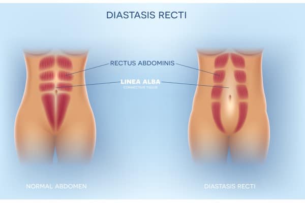 What Non-Surgical Options Are Available for Diastasis Recti Cardiff?