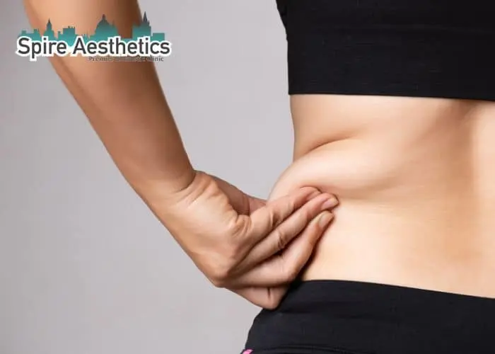 Image of woman pinching fat on their hips Cardiff. Fat Freezing treatment 