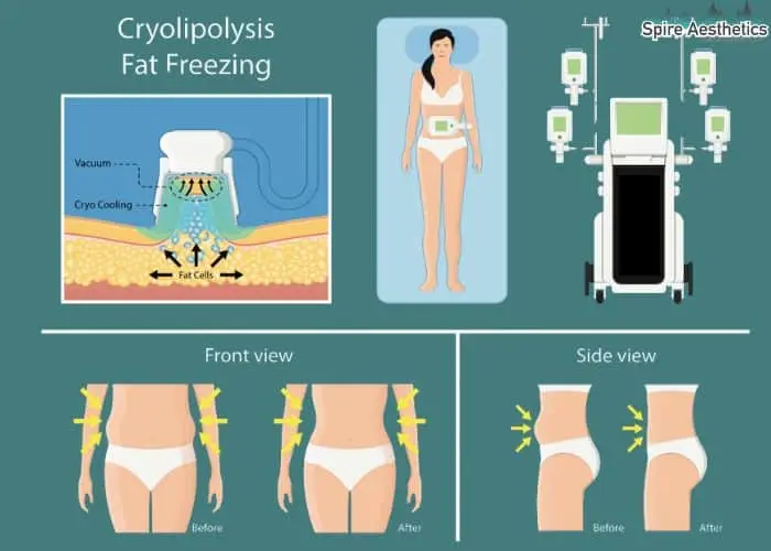 Fat freezing treatment Cardiff benefits for competitions to remove stubborn fat deposits.
