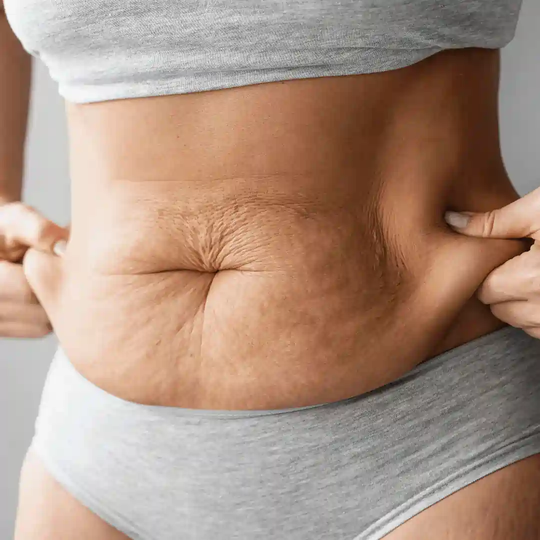 Is It Normal to Have Loose Skin After Pregnancy Cardiff?