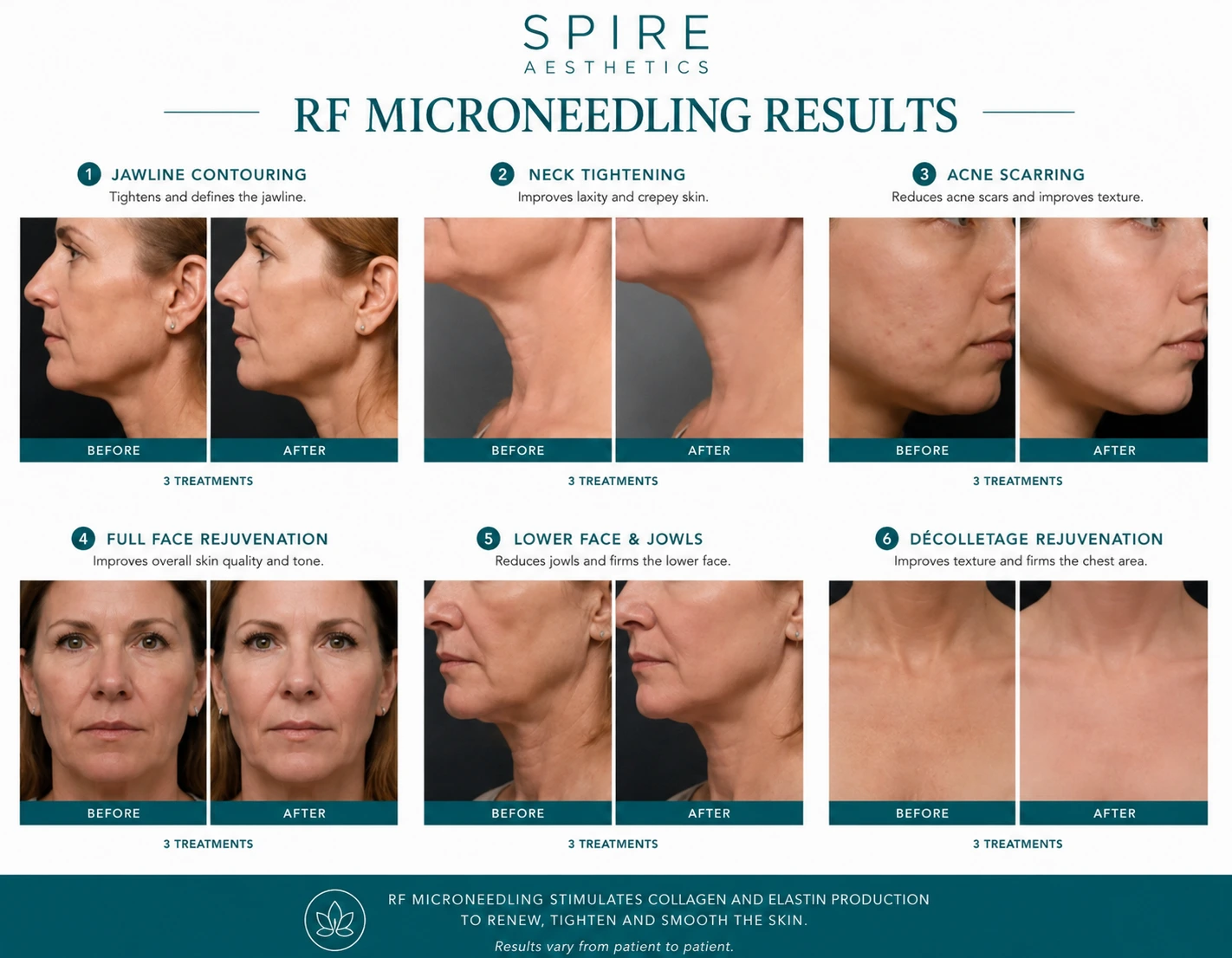 RF Microneedling Skin tightening Cardiff results