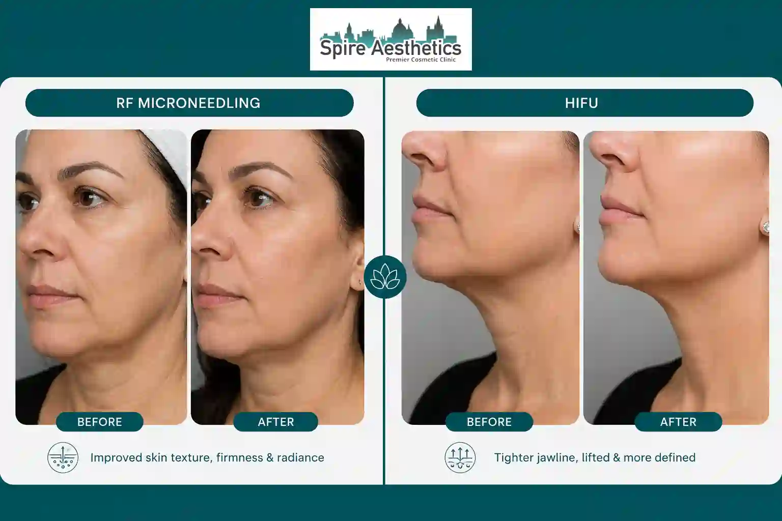 Can RF Microneedling and HIFU Be Combined Cardiff?
