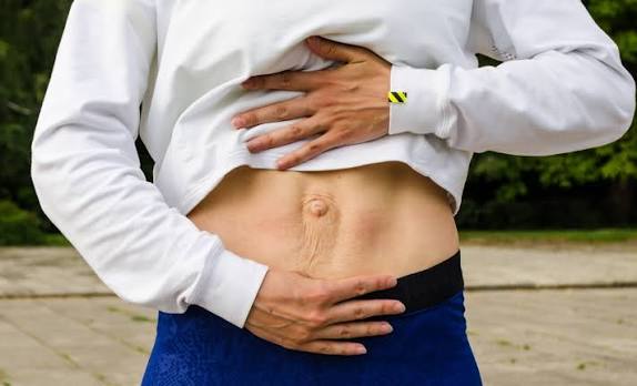 When Could Diastasis Recti Be the Missing Piece of the Puzzle Cardiff?