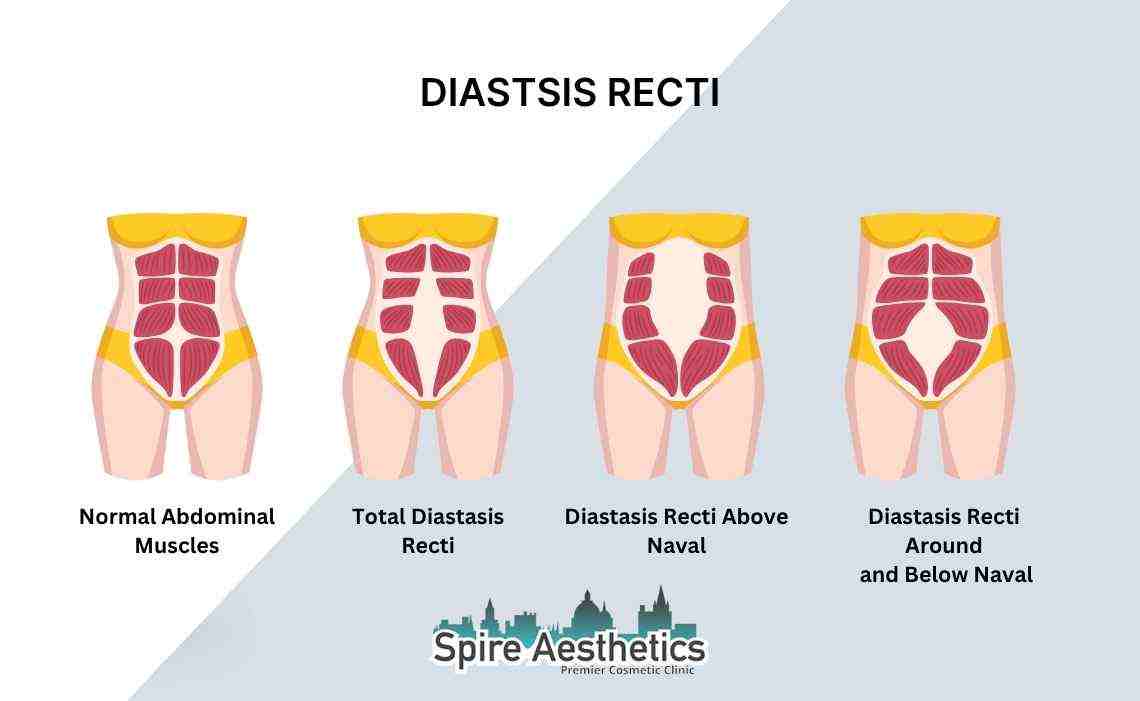 Is Non-Surgical Diastasis Recti Treatment Right for You? Common Concerns Answered Cardiff